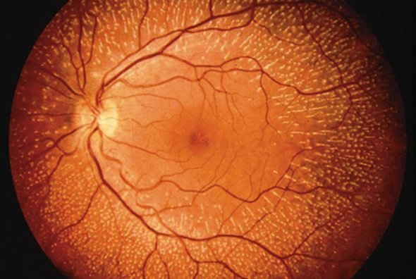 Retina biônica é produzida em Israel