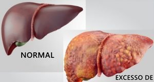 Dia internacional de combate à gordura no fígado discute problema que atinge 34% da população mundial