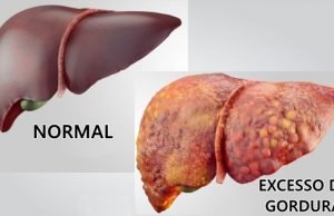 Dia internacional de combate à gordura no fígado discute problema que atinge 34% da população mundial