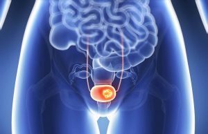 Cuidados para a prevenção e tratamento do câncer de bexiga